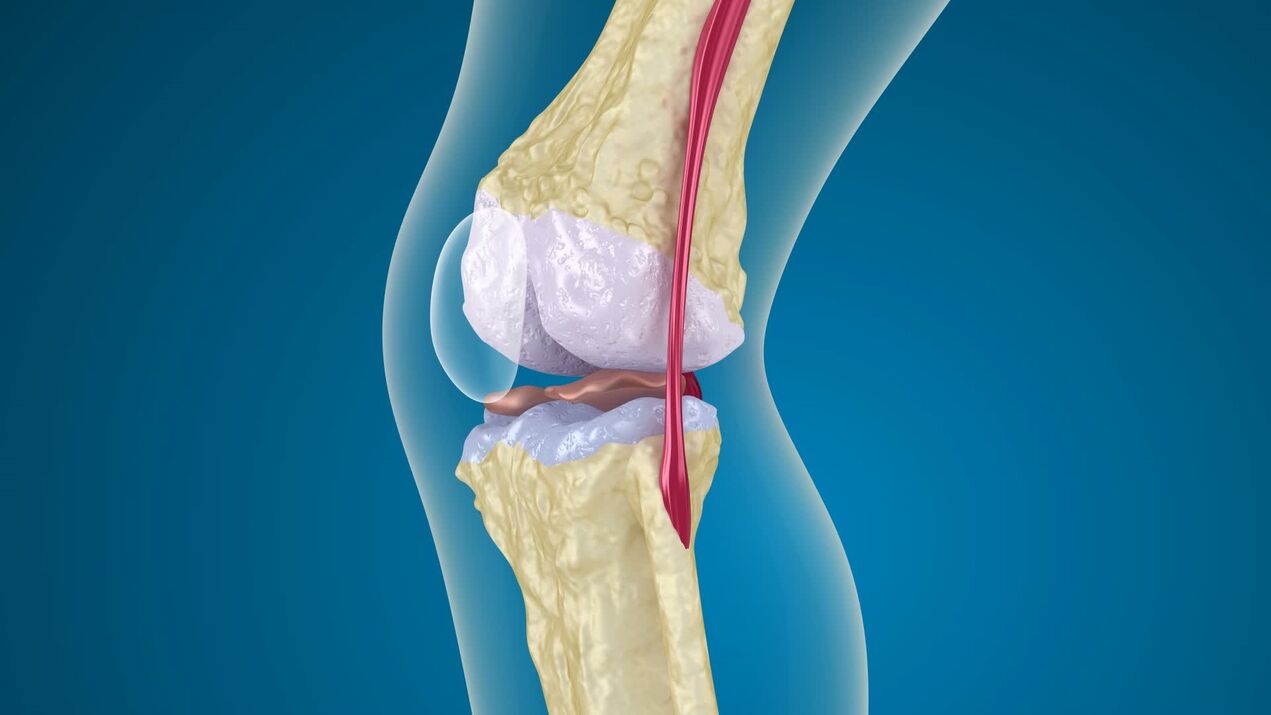 Destrucción de la articulación de la rodilla en la osteoartritis. 