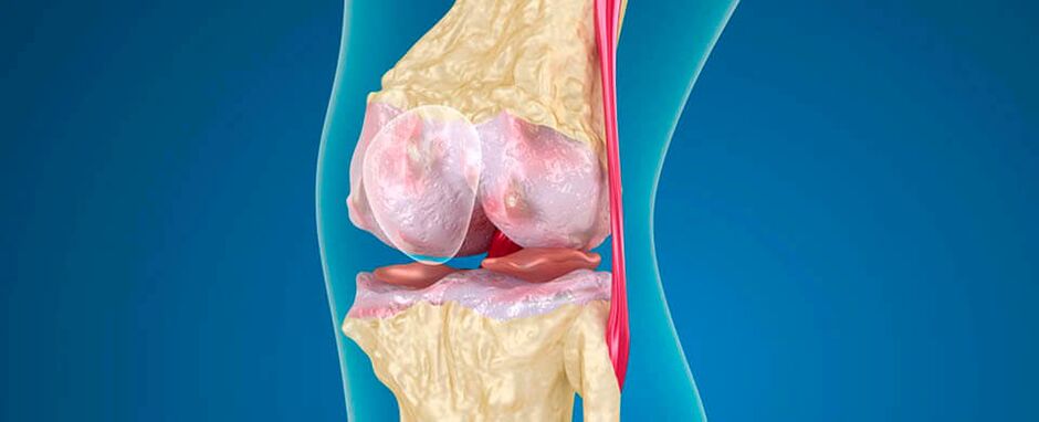 La artrosis de rodilla como causa del dolor