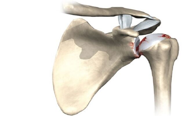 Lesión en la articulación del hombro por artrosis