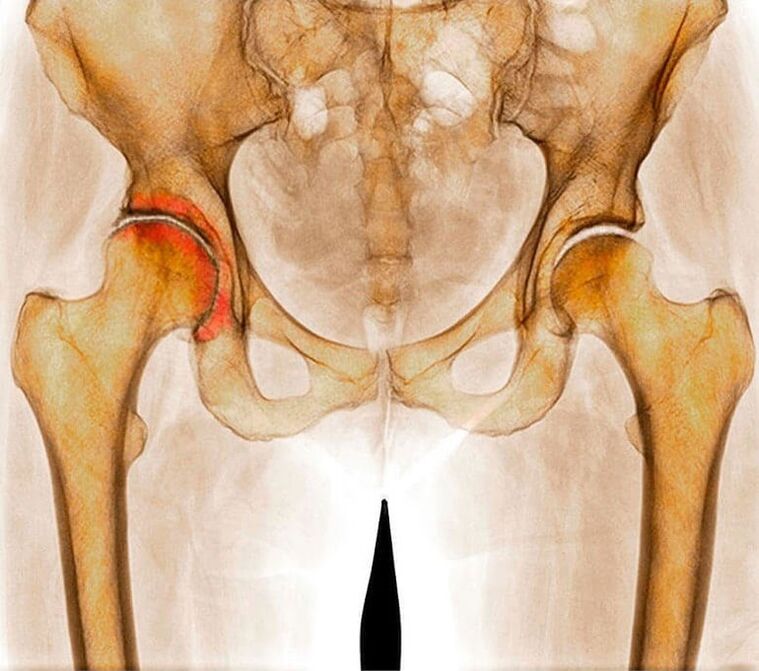 Inflamación de la articulación de la cadera como causa del dolor. 