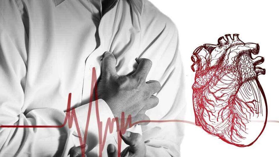 La extrasístole puede ocurrir debido a una arritmia cardíaca en la osteocondrosis torácica. 