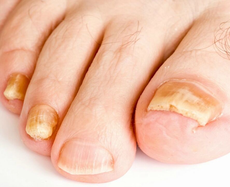 Champiñones en las uñas