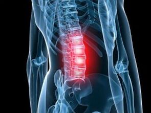 Osteocondrosis de la columna lumbar