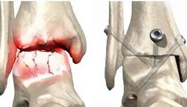 Tratamiento quirúrgico de la osteoartritis de rodilla