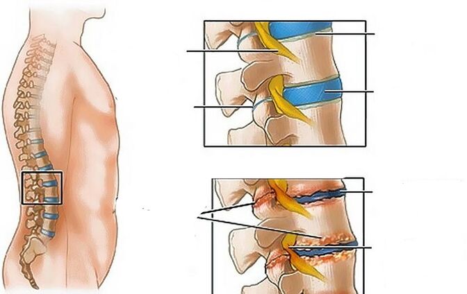 Osteocondrosis de la región lumbar
