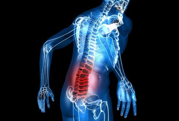 Síntomas de la osteocondrosis