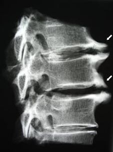 Los osteofitos de la columna cervical causan dolor de cuello.