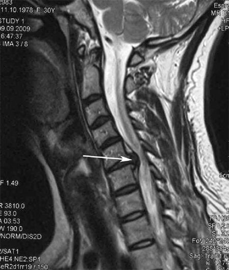 Una lesión en la médula espinal causa dolor de cuello
