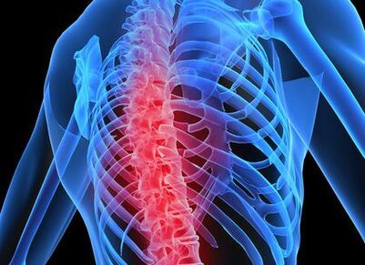Osteocondrosis de la columna torácica.