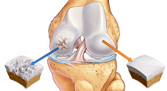 cartílago sano afectado por la osteoartritis