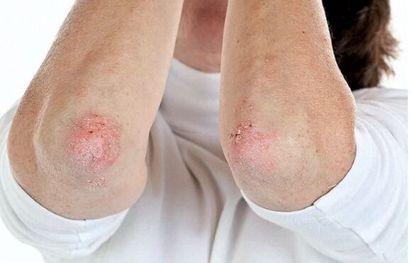 Las personas con psoriasis son susceptibles a la artritis psoriásica