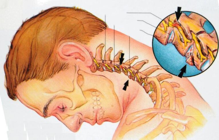 ¿Qué sucede con la osteocondrosis cervical