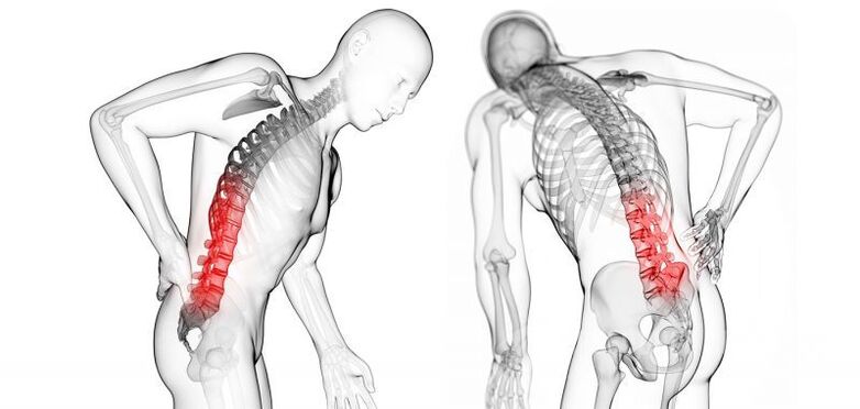 Complicaciones de la osteocondrosis cervical.