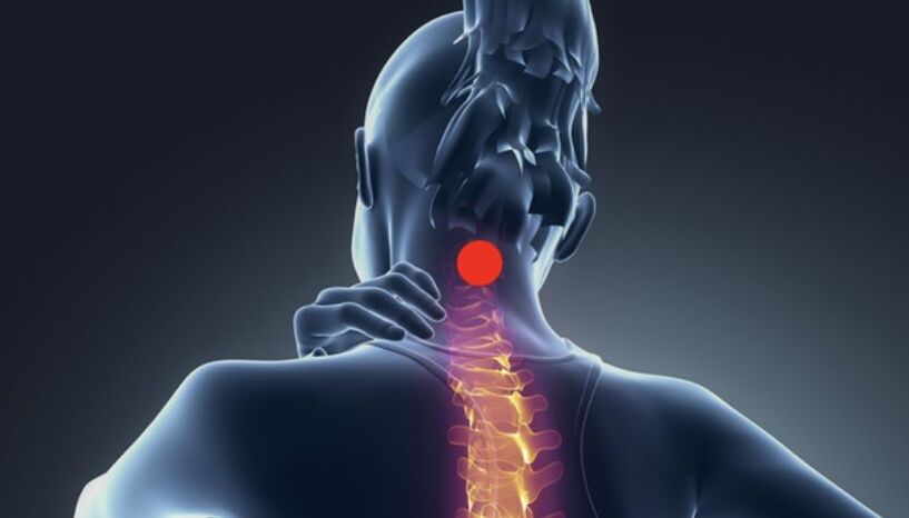 Síntomas de la osteocondrosis cervical.