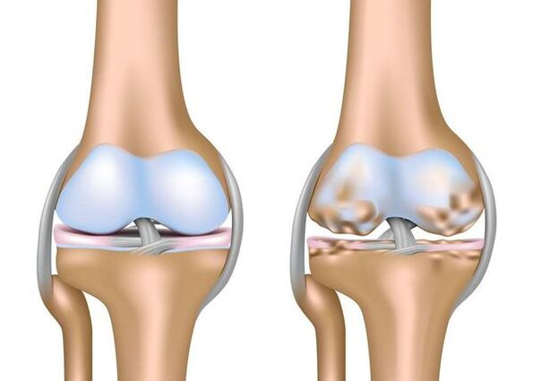 Osteoartritis