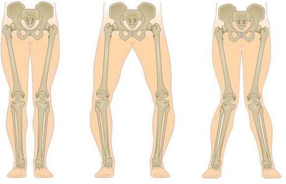 Tipos de osteoartritis