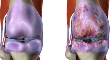 Las principales diferencias entre la artritis y la artrosis
