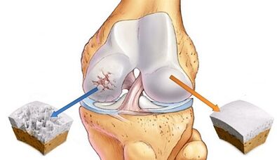 Las razones para el desarrollo de la osteoartritis de las articulaciones