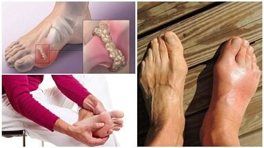 ¿Qué es la artritis de las articulaciones
