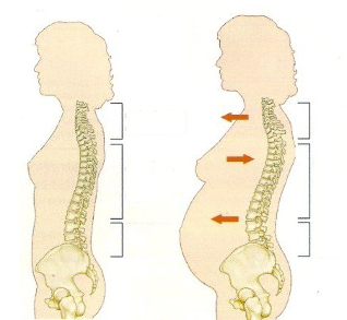 Osteocondrosis durante el embarazo. 